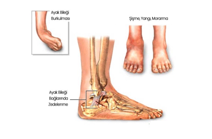 Burkulma Nedir? Burkulma Nedir?