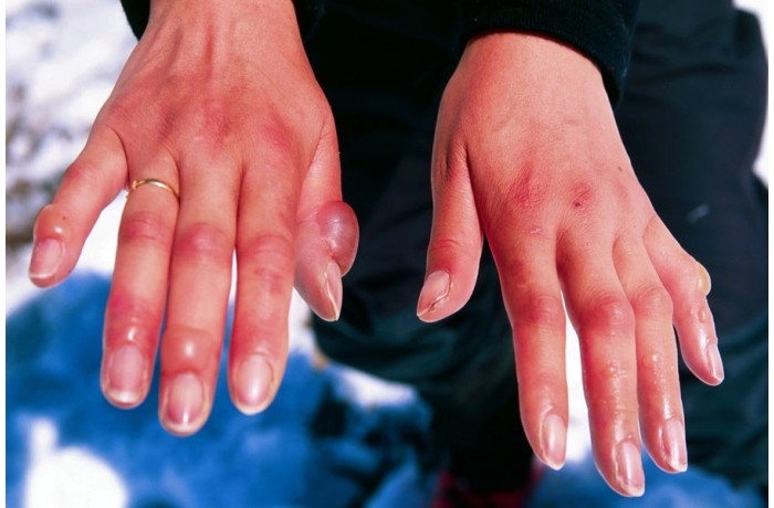 Donuklarda ilkyardım nasıl yapılır? Donuklarda ilkyardım nasıl yapılır?