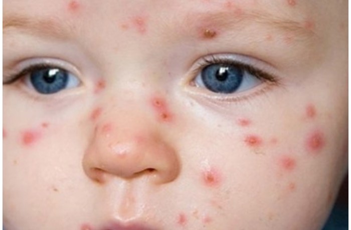 Hastalıklar Hastalıklar