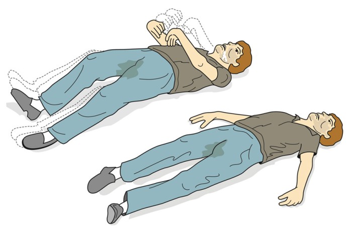 Sara (Epilepsi) krizi nedir? Sara (Epilepsi) krizi nedir?